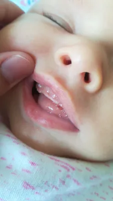 Жемчужинки на деснах грудничков👶. ⠀... - Детский стоматолог | Facebook