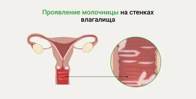 Геморрой у женщин - симптомы и лечение - диагностика геморроя