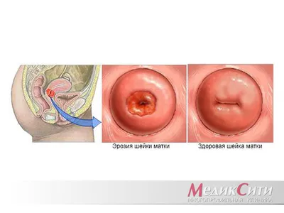 Патология шейки матки (эрозия врожденная и истинная, псевдоэрозия).  Диагностика и лечение