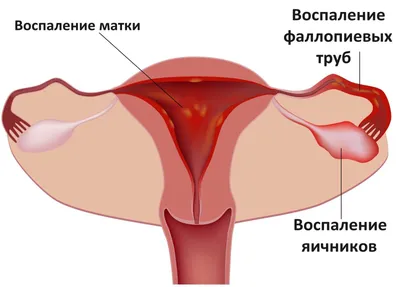 Плазмолифтинг интимной зоны - безопасный плазмолифтинг половых губ в Киеве  | Клиника Gold Laser
