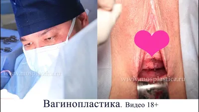 Видео: операция вагинопластика. 18+