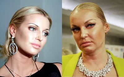 Жертвы ботокса: российские знаменитости в погоне за красотой! | PROFFLESSON  | Дзен