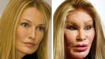 Женщины до и после ботокса - 72 фото