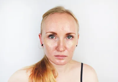 Лечение проблемной кожи лица в Одессе - клиника Доктора Лилианы