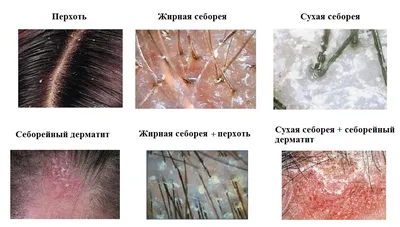 Жирная себорея кожи головы: фото, терапия, отзывы