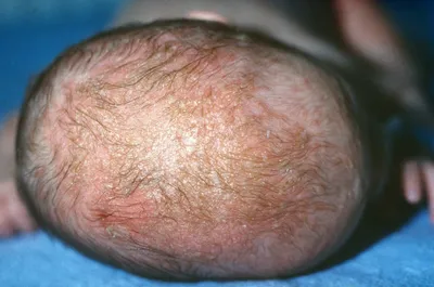Себорея кожи головы: причины и лечение сухой и жирной себореи