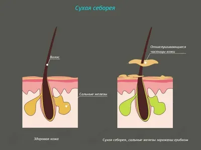 Себорейный дерматит у детей: причины, особенности лечения в 4, 6, 7, 8, 9  лет