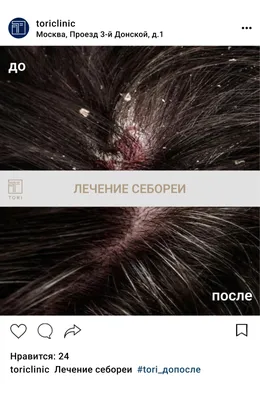 АЛЛЕРГОЦЕНТР САНМЕД СЕРВИС on Instagram: \"Себорейный дерматит (СебД) –  распространенная хроническая или рецидивирующая форма дерматита, которая в  основном затрагивает богатые сальными железами участки кожи головы, лица и  туловища. ▶️Причина до конца не