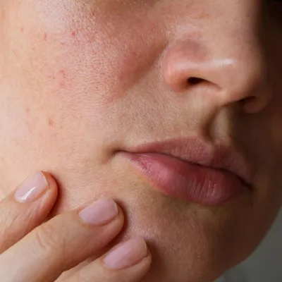 Жирная кожа головы и лица. Как предотвратить развитие себорейного дерматита?