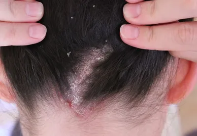 Сухая себорея – лечение | Как лечить сухую себорею кожи головы?
