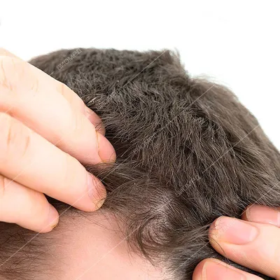 Лечение себореи головы и волос в Санкт-Петербурге — БИОМЕД