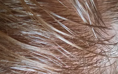 Могут ли проблемы с кожей головы вызывать выпадение волос - 13 Июня 2013 -  БЛОГ - Все о здоровье волос