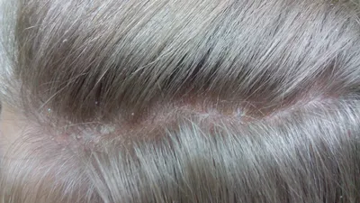 Сухая и жирная себорея волосистой части головы | ZOJ.KZ | Дзен