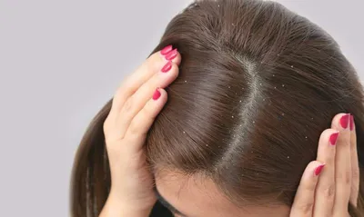 Лечение себореи кожи головы: косметические средства от компании Sesderma