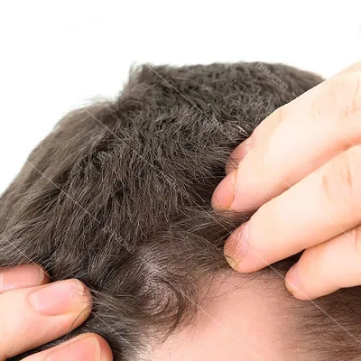 Лечение себореи головы и волос в Москве — БИОМЕД
