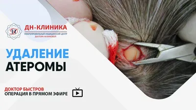 Удаление липомы: виды и способы операций, реабилитация - услуги Клиники 9 в  Жуковском и Раменском