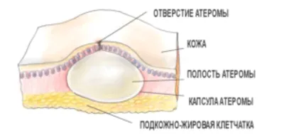 Атерома (жировик) – лечение в Москве в клинике доктора Назимовой