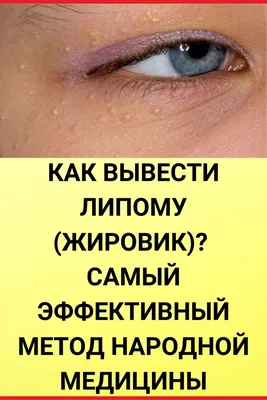 Желтые пятна на белке глаза: причины, диагностика и лечение в ГКДБ