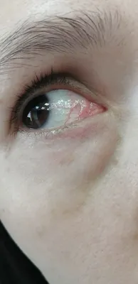 Белая точка на внутреннем уголке глаза - Вопрос офтальмологу - 03 Онлайн