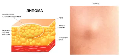 Удаление липом (жировиков), атером и фибром на лице и теле в клинике  лазерной хирургии «Вектор»