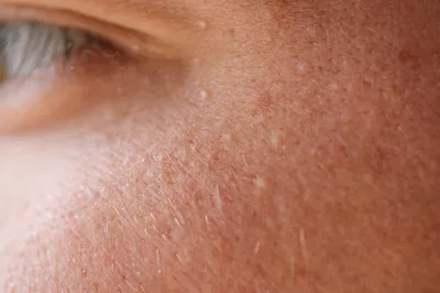Милиумы: как убрать под глазами, на лице белые прыщики, лечение мази |  Beauty Insider