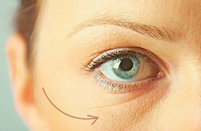 Удаляем жировые грыжи под глазами | Клиника косметологии и пластической  хирургии effi | Дзен
