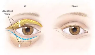 Пластика век в Новороссийске, лазерная блефаропластика глаз, цена операции  по контурной пластике век в микрохирургии - Клиника МХК