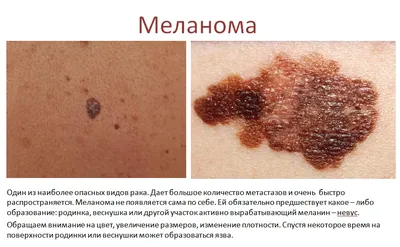 Рак кожи: фото, симптомы, плоскоклеточный, базальноклеточный, меланома