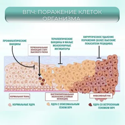 Рак шейки матки: симптомы, причины, лечение | doc.ua