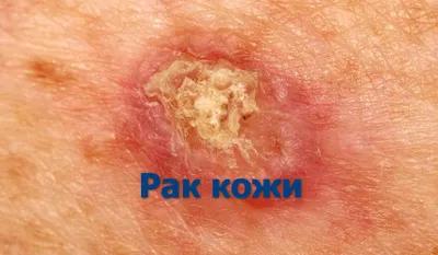 Доброкачественные и злокачественные опухоли кожи. Рекомендации пациентам. -  YouTube