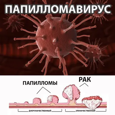 ВПЧ (вирус папилломы человека) | причины, симптомы, типы, диагностика и  лечение папилломавирусной инфекции