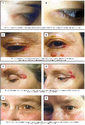 Как выглядит РАК КОЖИ (фото 1-8). Меланома, базалиома и плоскоклеточный рак  кожи - YouTube