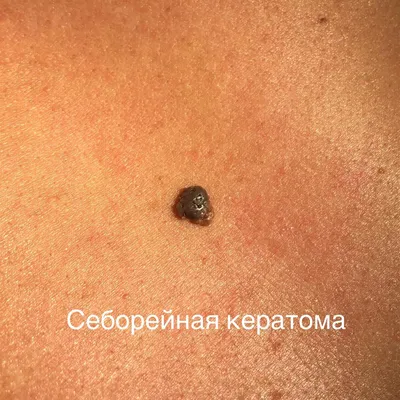 Дерматоонкология — nevus.pro