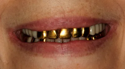 Золотые коронки на зубы фото фото