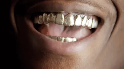 Золотые коронки - стоит ли ставить? | Стоматология Ас-Стом |  Санкт-Петербург (СПб)