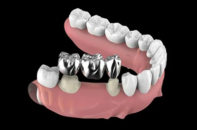 Коронка на зуб - описание, плюсы и минусы, все о зубных коронках | СВОИ ЛЮДИ