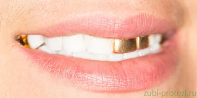 Восстановление зубов золотыми коронками: виды и технологии изготовления