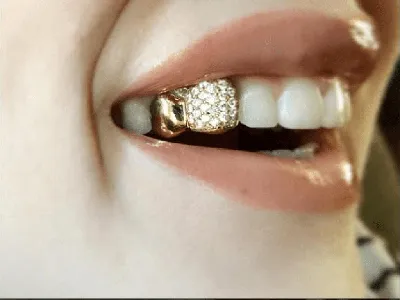 Скупка золотых зубов | Zalogoff.com | Дзен