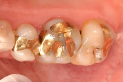 Коронки на зубы - цена в Москве | Стоматологическая клиника Гранцева