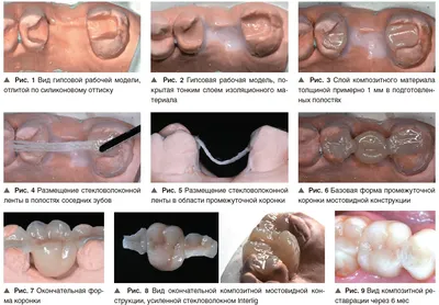 Шинирование зубов в Минске: методы, материалы, отзывы