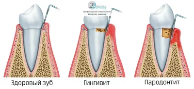 Протокол изготовления композитной мостовидной конструкции, усиленной  стекловолокном Interlig - МЕДЕНТА