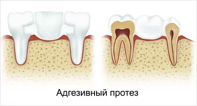 5 шт., гибкая полоса из стекловолокна для зубных протезов | AliExpress