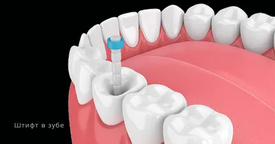 Шинирование подвижных зубов при парадонтозе стекловолокном, отзывы  пациентов и цены