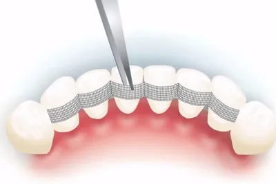 Шинирование зубов стекловолокном