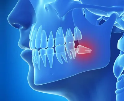 Зуб мудрости растет в щеку и болит - Стоматология в Томске
