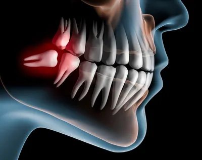 Зуб мудрости растет и болит десна: что делать, как снять боль | Dental Art