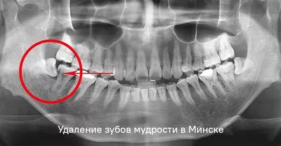 Что делать, если зуб вырос криво?