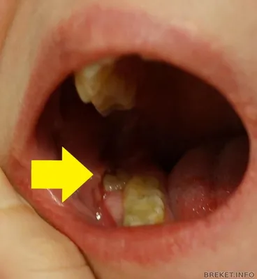 Удаление зубов мудрости в стоматологии Радикс в Крылатском