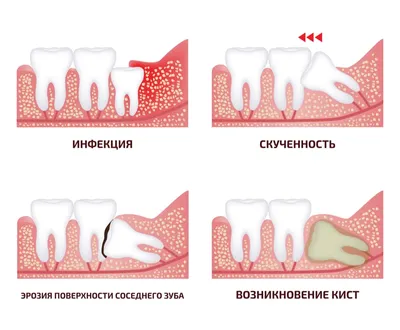 Зуб мудрости симптомы прорезывания — Что делать? И когда обратиться к  стоматологу?