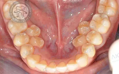Особенности зубов мудрости | Smart Clinic